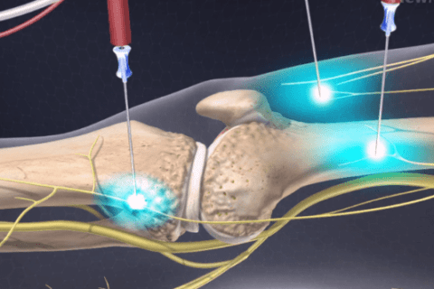 Radiofrequency ablation