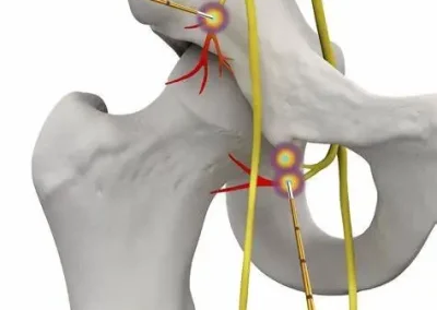 Radiofrequency ablation for Hip pain