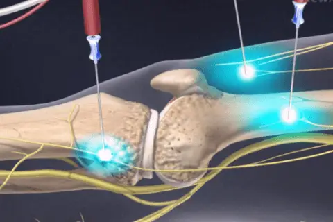 Can Prostate Cancer Be Cured