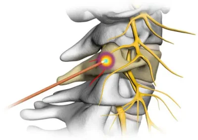 Radiofrequency ablation for back pain